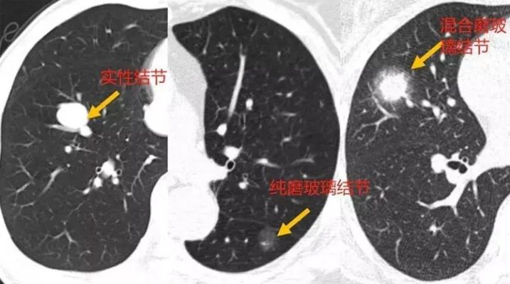 肺部小结节的成因及治疗方法介绍-第3张图片-www.211178.com_果博福布斯